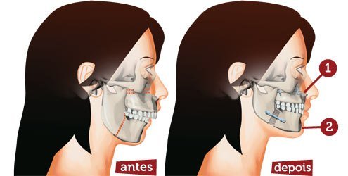 Cirurgia ortognática: entenda como funciona