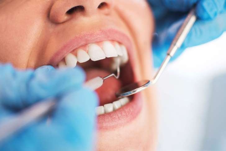 Perda de coágulo após extração dentária pode causar alveolite