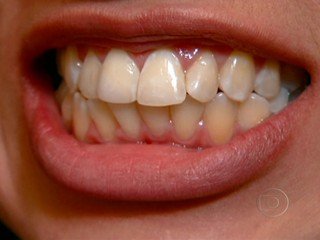 Falta de fio dental pode causar sangramentos e doenças na gengiva