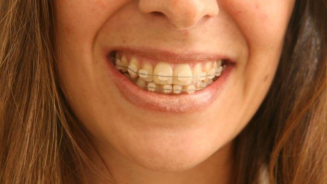 Posicionamento errado da língua pode contribuir para dentes tortos